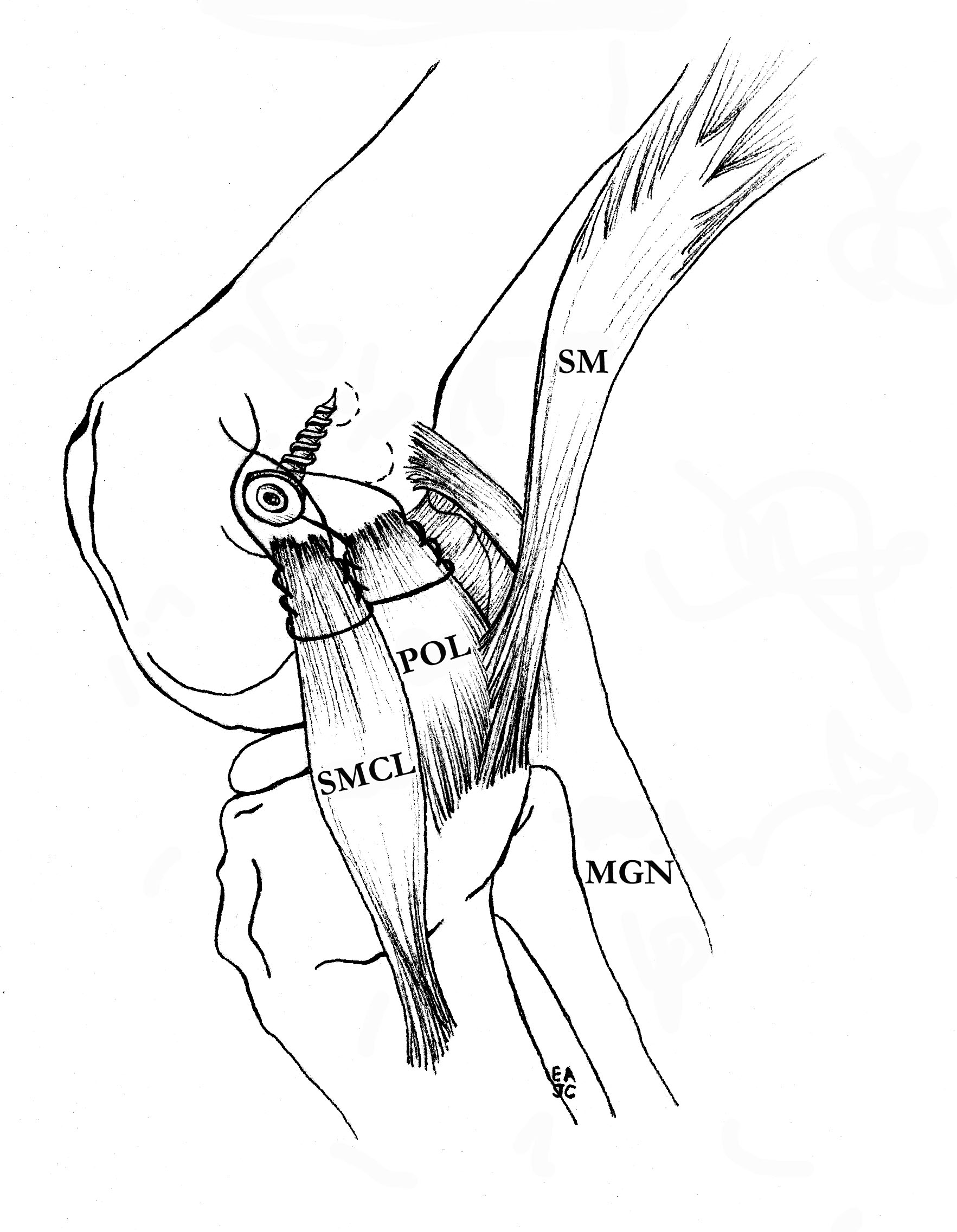 Proximal MCL Advancement 2